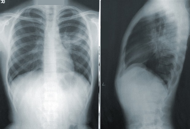 Side by side x-rays showing the upper rib cage