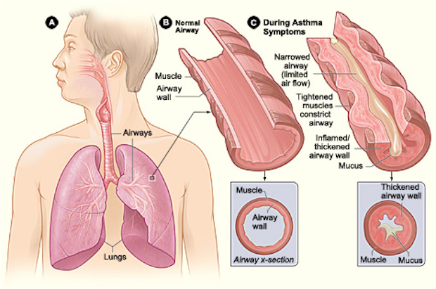 A diagram of how airways swell in asthma patients